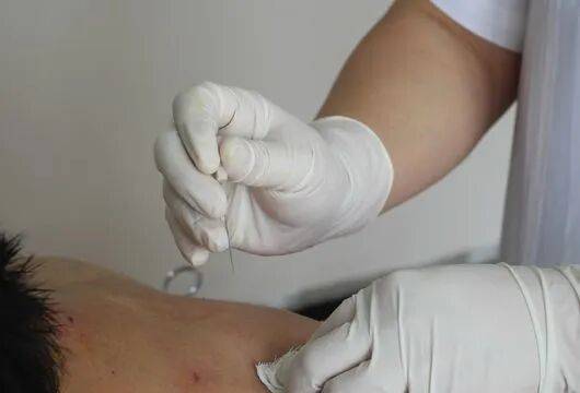 针刀操作技巧 初学者必看