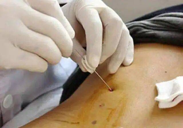 针刀操作技巧 初学者必看